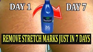 Remove Stretch Marks Fast and Easily  2 Remedies to Remove Pregnancy Stretch Marks in 7 Days [upl. by Fulmer]