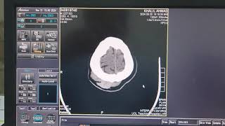 Scalp Heamatoma on CT Brain [upl. by O'Callaghan790]