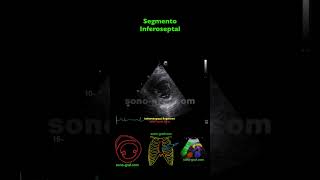 Ecocardiografía  Hipocinesia Inferolateral E Inferior [upl. by Reitrac451]