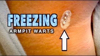 FREEZING ARMPIT WARTS With Liquid Nitrogen  Dr Paul [upl. by Aleron647]