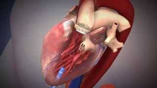 Edwards SAPIEN Transcatheter Heart Valve with the Ascendra Transapical Delivery System [upl. by Philis]