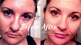 MY FACE CHANGED  ACNE GONE  ANTI AGING  RAW FOOD VEGAN [upl. by Dolorita315]