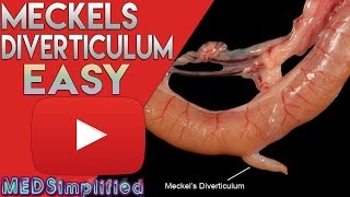 Meckels Diverticulum Made Easy [upl. by Lebbie]