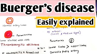 Buergers disease  Thromboangitis obliterans  Definition causes pathophysiology treatment [upl. by Nannerb]