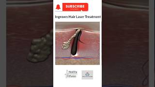 Ingrown Hair Laser Treatment  HealthyFitFusion195 shorts viralshorts medicaleducation facts [upl. by Strauss]