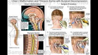 Living with Chiari Malformation [upl. by Leveroni]