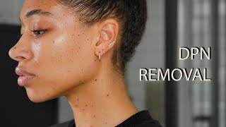 Dermatosis Papulosa Nigra DPN Removal [upl. by Whitehouse420]