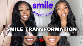 The Truth About Smile Direct Club  Treatment Plan amp Review  My Experience [upl. by Gemoets]