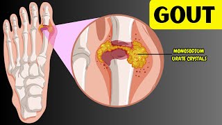 Understanding Gout  Causes Risk Factors Signs amp Symptoms Diagnosis amp Treatment [upl. by Nostaw852]