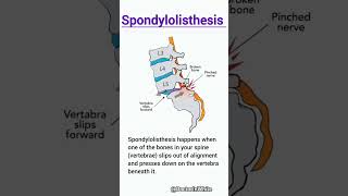 Spondylolisthesis  viralshorts spondylolisthesis vertebrae spinalcord [upl. by Shreve421]