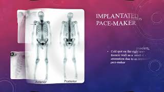 Artifacts in bone scintigraphy MCQs nuclearmedicineMCQ nuclearmedicine RSO frcr bonescan [upl. by Sidnal]