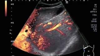 Ultrasound Video showing Hepatic parenchymal disease in a young patient of about 23 years [upl. by Rama]