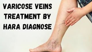 Varicose Veins Treatment by Hara Diagnose  9463086527  Gurnam Singh [upl. by Luas707]