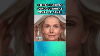 Ojeras Bótox Como Quitarlas 4 [upl. by Meibers]