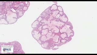 Craniopharyngioma papillary microscopy  Talking slide [upl. by Nylleoj]