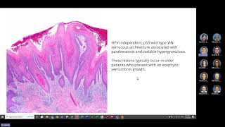 VIN vuval intraepithelial neoplasm [upl. by Ilrac]