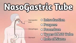 Nasogastric Tube Intubation [upl. by Inal]