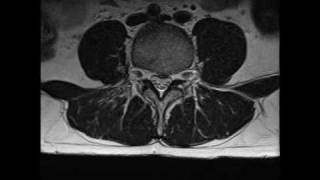 MRI of lumbar spine L4 L5 S1 disc bulge [upl. by Naasar]