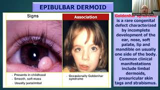 OCULAR NEOPLASMS [upl. by Aerdnna]