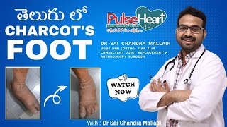 Charcots Foot గురించి ఇది షుగర్ పేషంట్స్ లో సాధారణంగా వస్తుందిDr Sai Chandra [upl. by Ehcsrop]