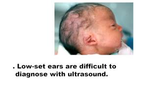 2 and 3 trimester normal for sonographers [upl. by Yor]