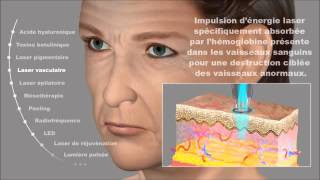 Laser vasculaire Couperose érythrose angiomes Dermatologue à Pau Tarbes [upl. by Karlik]