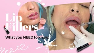 Lip Fillers What you should know [upl. by Nihs]