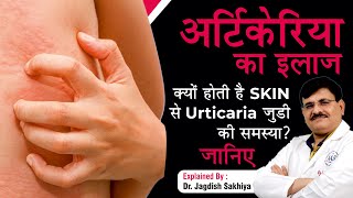 Urticaria Hives Causes Symptoms amp Treatment  In Hindi   Dr Jagdish Sakhiya Skin Clinic [upl. by Galasyn]