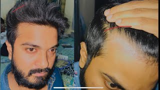 Dermaroller hair regrowth with proof and results dermaroller minoxidil hairgrowth [upl. by Yanad854]