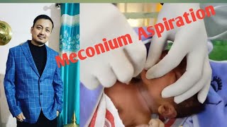 🤮😱Dirty Meconium aspiration  newborn baby [upl. by Hollander]