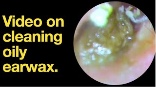 Video on cleaning oily earwax ear wax removal  ear cleaning  ASMR  relaxation  relax [upl. by Bove66]