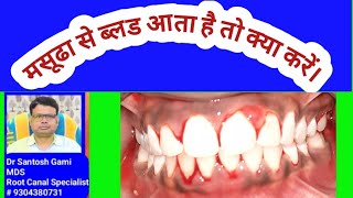 मसूढा से ब्लड आता है तो क्या करें। Bleeding comes from Gum  What have to Do [upl. by Severin]