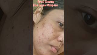 glocin gel how to use effects ampsideffects full detail reviewbest for acne pimplestrendingonshorts [upl. by Riggins]