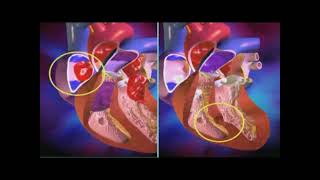 Cardiopathie congénitale [upl. by Terhune]