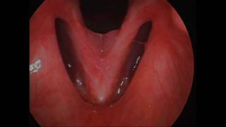 MGHVoice Center RRP 3a  PreTreatment Severe scarring and hoarseness [upl. by Newkirk]