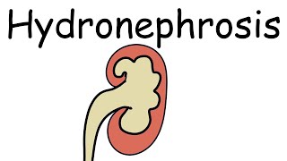 What is Hydronephrosis Causes Presentation Complications and Treatment  Pathology mini tutorials [upl. by Odraccir]