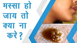 Best treatment of wart in Hindi with English subtitles [upl. by Bruner]