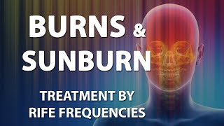 Burns amp Sunburn  RIFE Frequencies Treatment  Energy amp Quantum Medicine with Bioresonance [upl. by Eleda]