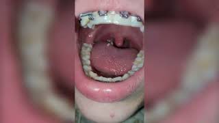 Deep Tonsil Stone Removal  Tonsil Stones [upl. by Kinelski235]