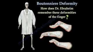 Boutonniere Deformity  Everything You Need To Know  Dr Nabil Ebraheim [upl. by Eliam]