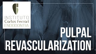 Pulpal revascularization [upl. by Onfroi]