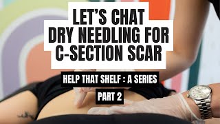 Dry Needling For A CSection Scar  Help That Shelf  A Series  Part 2 [upl. by Kayle]