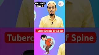 Tuberculosis of spine treatment shorts tuberculosisofspine spine [upl. by Ardnal547]