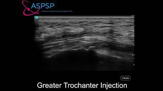 Ultrasound Guided Greater Trochanteric Bursa Injection [upl. by Aileduab706]