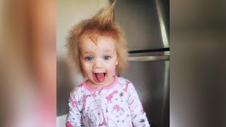 Childs Uncombable Hair Syndrome Explained [upl. by Yekcor289]