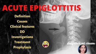 166Acute Epiglottitis  treatment of acute epiglottitis stridor epiglottis [upl. by Euqinu435]