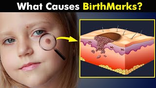 Birthmarks  How Birth Marks Develops In Our Skin UrduHindi [upl. by Fulvia]