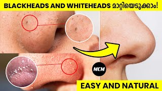 How to Remove Blackheads and Whiteheads Naturally at Home  Malayalam Skincare Video for Men [upl. by Leahcim]