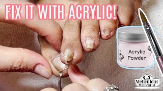 How to use Acrylic to Fix a Pincer Toenail Tutorial [upl. by Cynthie538]