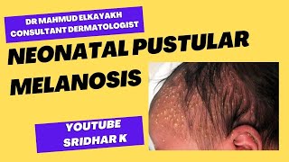 Neonatal pustular melanosisa dermatologists perspective rash newbornrash pustularmelanosis [upl. by Apthorp]